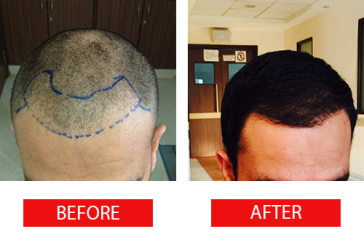 Tips For Hair Transplant Procedures in Singapore